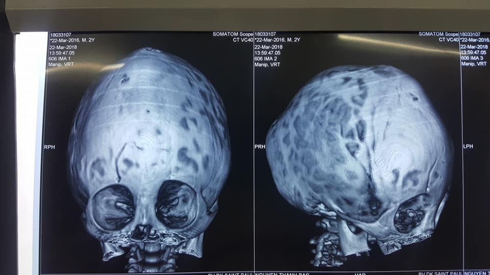 Hình ảnh chụp sọ não của bệnh nhi Nguyễn Thanh B.
