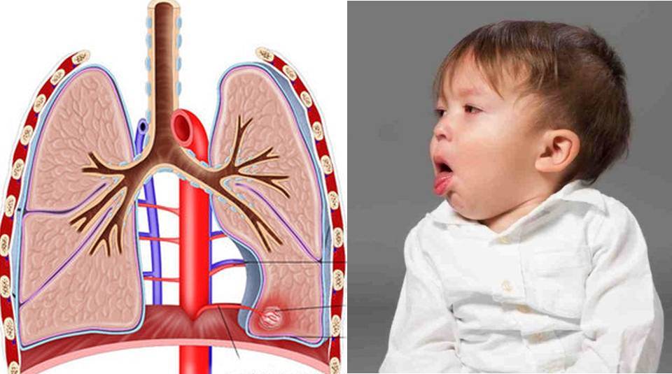 Khi trẻ có các triệu chứng ho, khò khè kéo dài, viêm phổi thường xuyên tái phát cần đưa trẻ đi thăm khám để phát hiện sớm bệnh lý