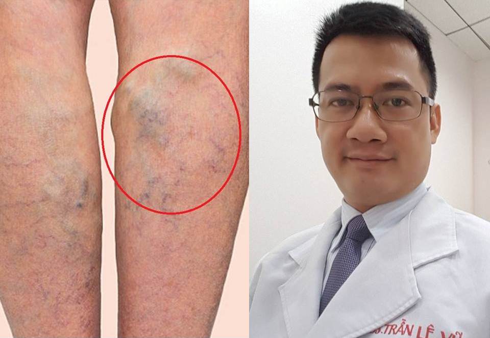 Bác sĩ Trần Lê Vũ, phòng khám CarePlus cho biết hiện tượng bị sưng, mỏi chân, nặng bắp chân, kiến bò dọc cẳng chân là dấu hiệu cảnh báo của bệnh suy giãn tĩnh mạch