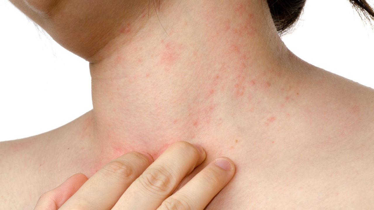 Việc cào gãi ngứa khi da bị bệnh càng làm da sây sát dễ bị bội nhiễm vi khuẩn