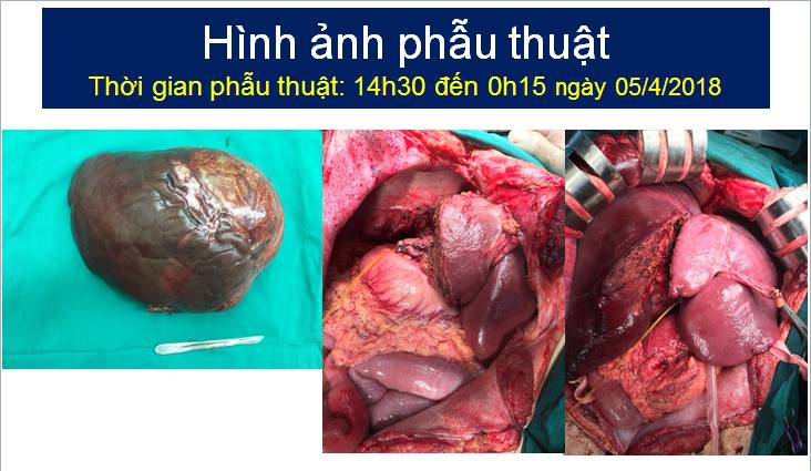 Khối u gan nặng 5kg được lấy ra từ người bệnh nhân Nguyễn Hữu A. 