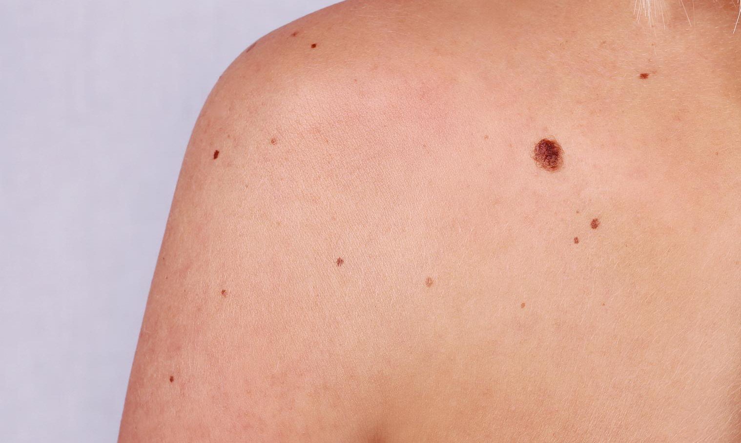 Các nốt ruồi có kích thước không cân đối, màu sắc bất thường đều là những dấu hiệu sớm của bệnh ung thư da