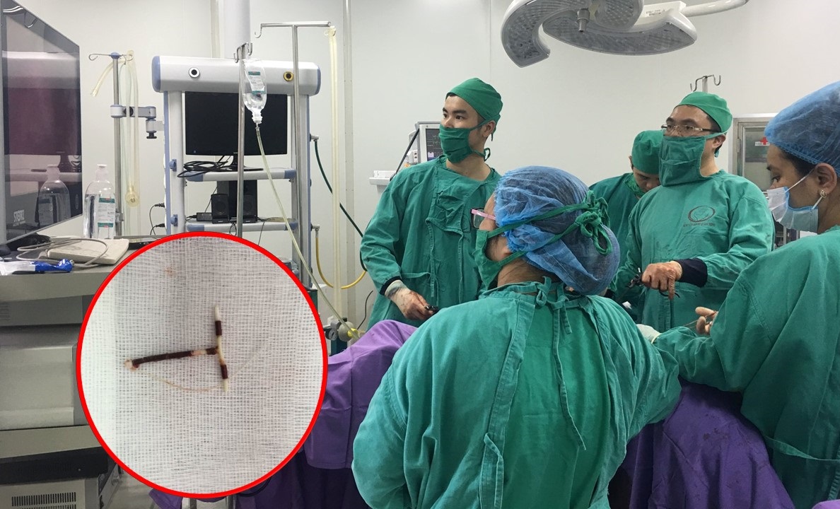 Các bác sĩ của Bệnh viện Sản Nhi Quảng Ninh tiến hành phẫu thuật nội soi lấy vòng tránh thai lạc chỗ trong ổ bụng bệnh nhân Vũ Thị T.
