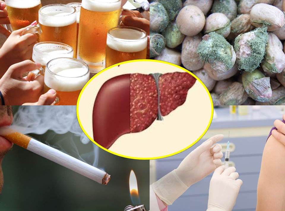 Hạn chế bia, rượu, không hút thuốc, không ăn các loại hạt mốc... có tác dụng phòng ngừa ung thư gan hiệu quả