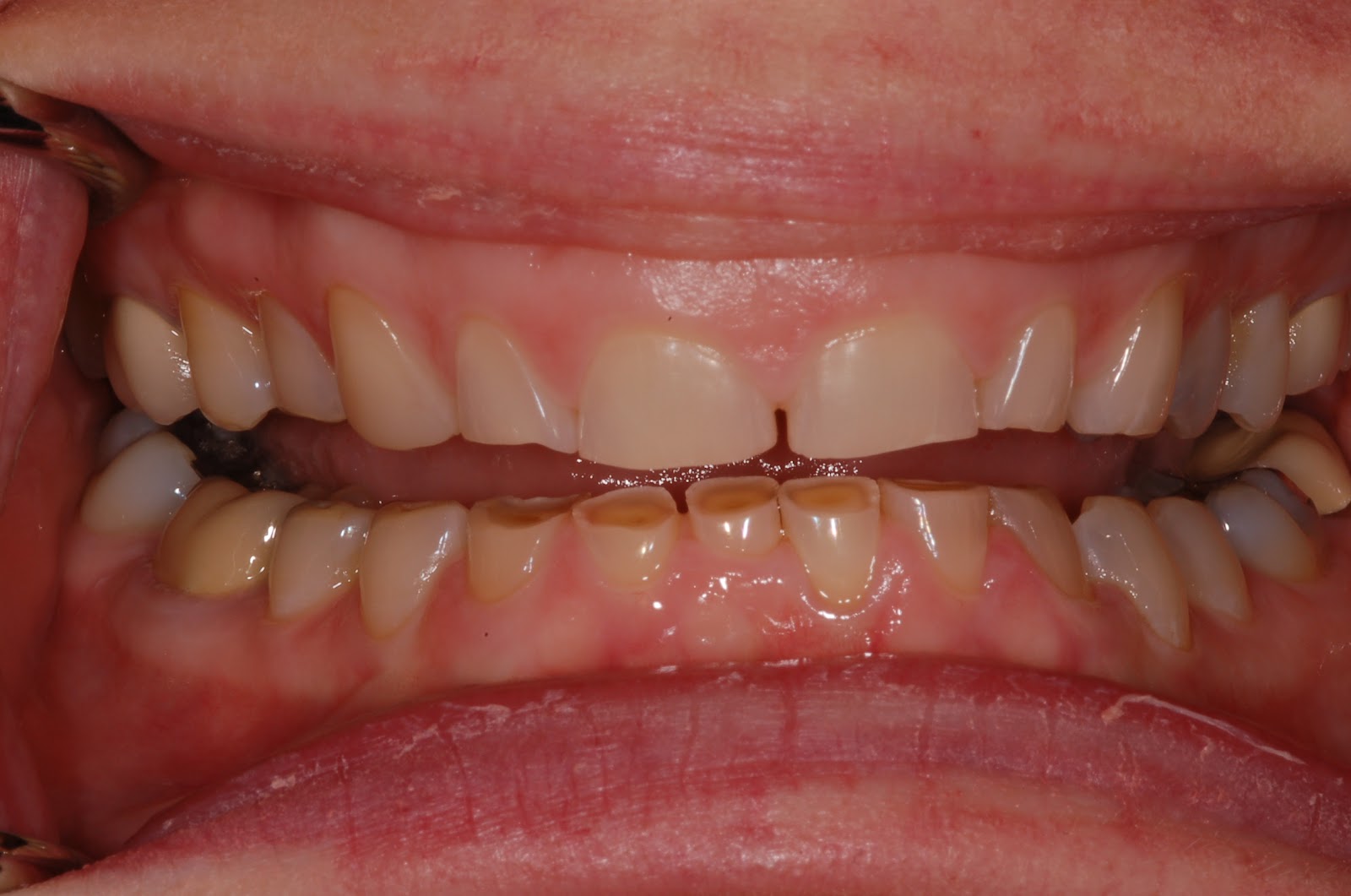 Bề mặt răng của người bị trào ngược dạ dày thực quản thường bị bào mòn