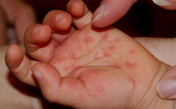 Trẻ bị tay chân miệng thường có biểu hiện trẻ sốt, tổn thương da ở lòng bàn tay, lòng bàn chân