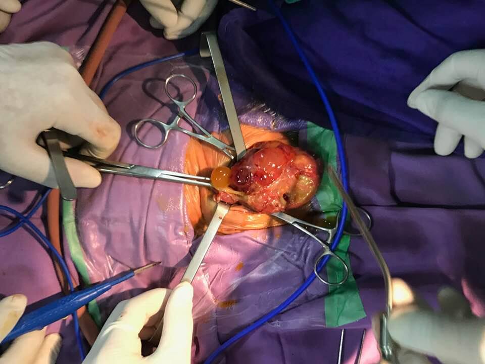 Các bác sĩ của Bệnh viện Sản Nhi Quảng Ninh tiến hành phẫu thuật lấy khối u trung thất cho bệnh nhi Bàn Kim M. 