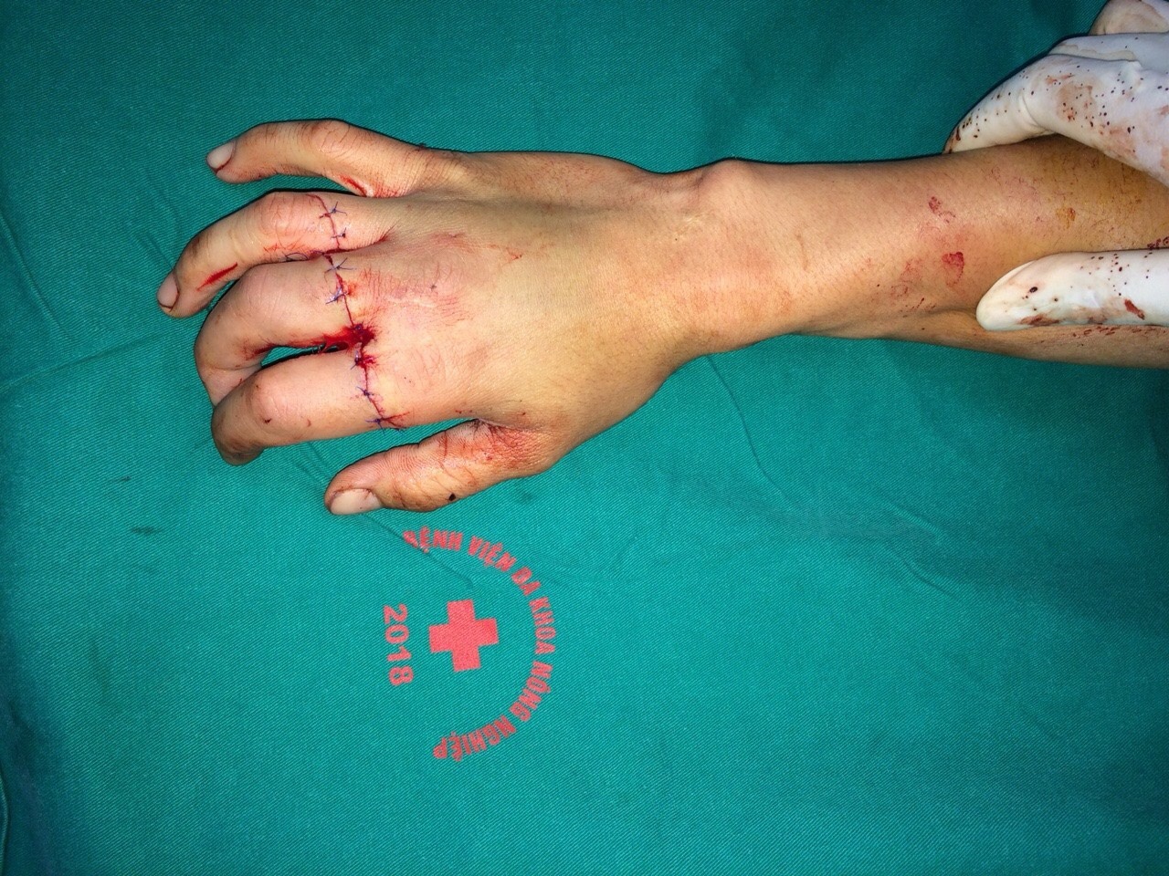 Tay của bệnh nhân D.V.H. sau khi được các bác sĩ của Bệnh viện ĐK Nông Nghiệp phẫu thuật nối 2 ngón tay
