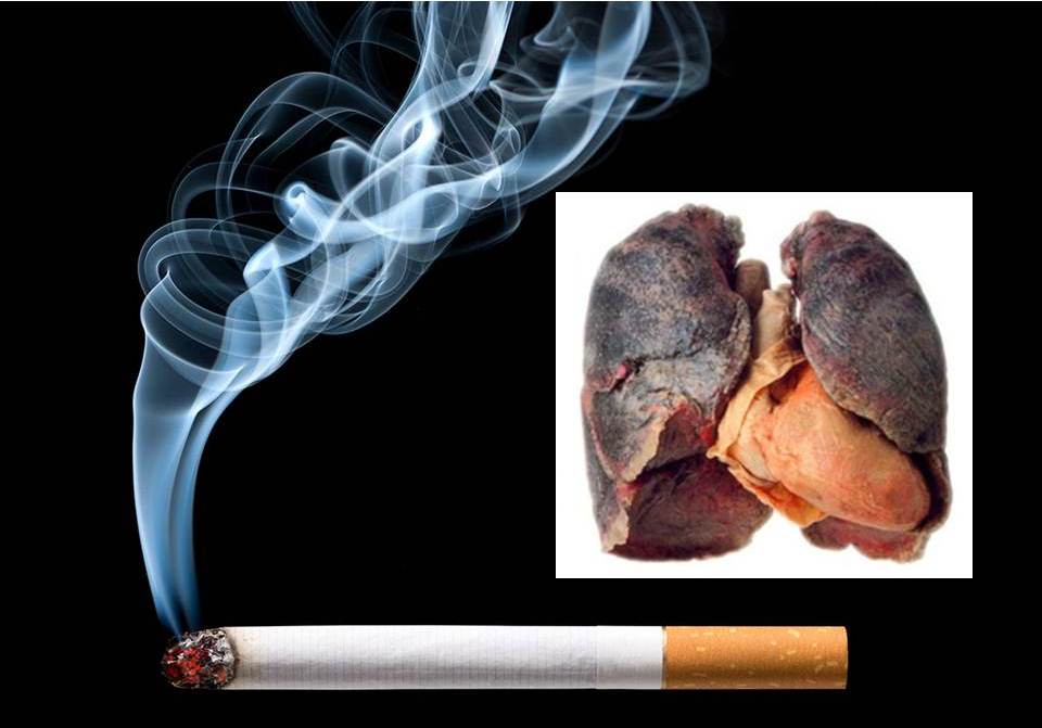 Hút thuốc lá làm tăng nguy cơ gây ung thư phổi