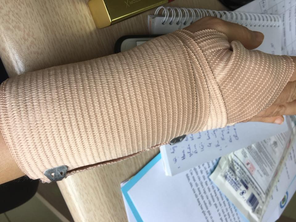 Cánh tay bị chấn thương của chị Hiền do chơi trò đi xe điện cân bằng