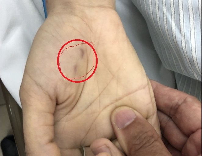 Vết chó cắn trên bàn tay bệnh nhân C. sau 1,5 tháng