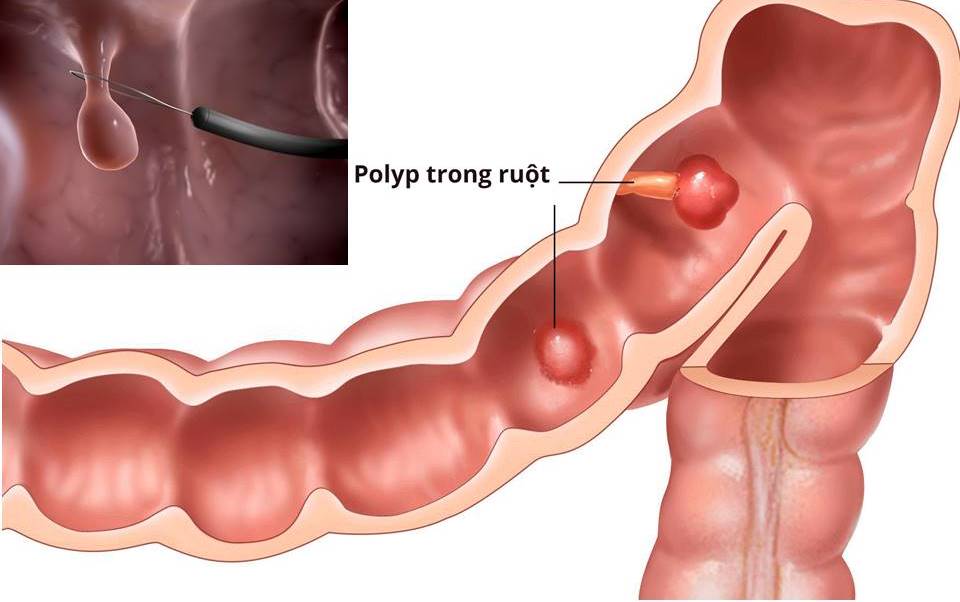 Cắt bỏ các polyp đại tràng sớm giúp giảm nguy cơ ung thư đại tràng