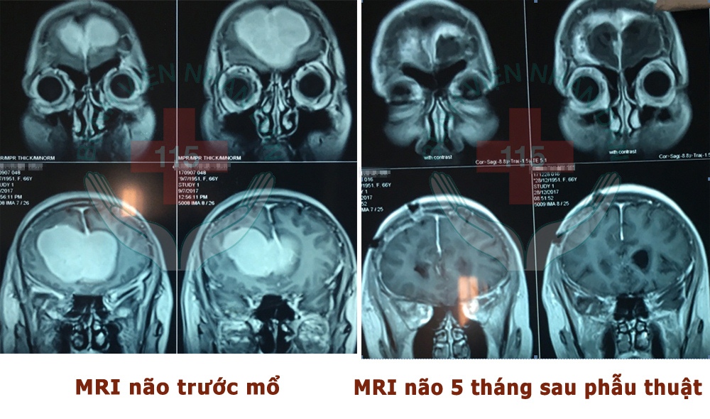 Hình ảnh chụp não bệnh nhân Đ.T.M. trước và sau phẫu thuật lấy u màng não