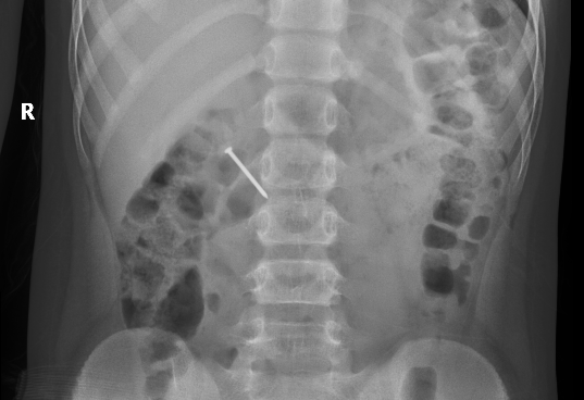 Hình ảnh chụp X-quang cho thấy dị vật nằm trong lòng tá tràng của bệnh nhi