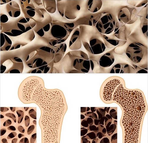 Người loãng xương có nguy cơ bị gãy xương tăng gấp 2 - 3 lần so với người có mật độ xương bình thường