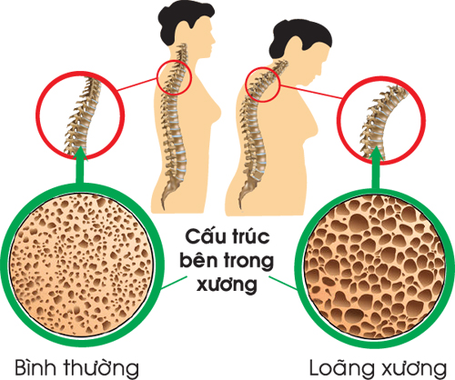 Loãng xương gây đau cột sống cổ hoặc cột sống thắt lưng, gù lưng và giảm dần chiều cao