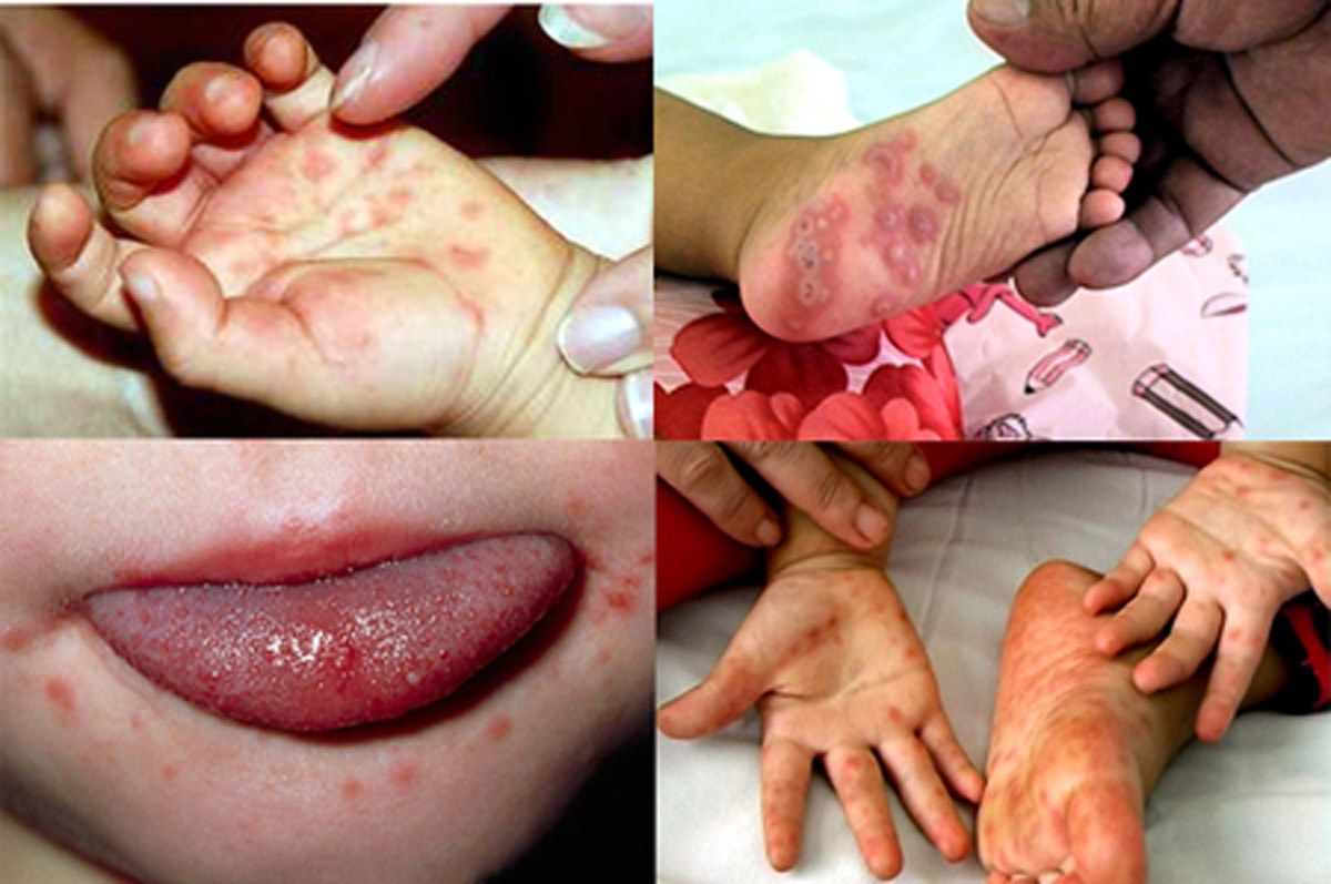 Biểu hiện của bệnh tay chân miệng ở trẻ nhỏ