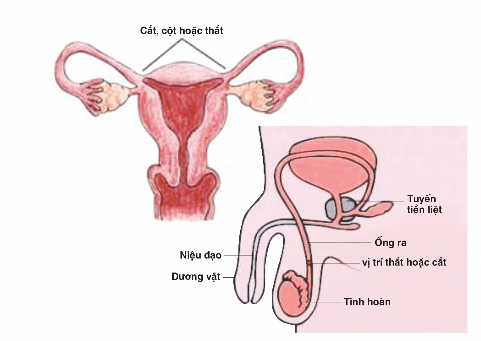   Triệt sản là phương pháp ngừa thai vĩnh viễn ở cả nam và nữ  