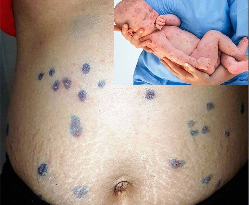 Trẻ có thể mắc hội chứng thủy đậu bẩm sinh khi mẹ bầu bị thủy đậu