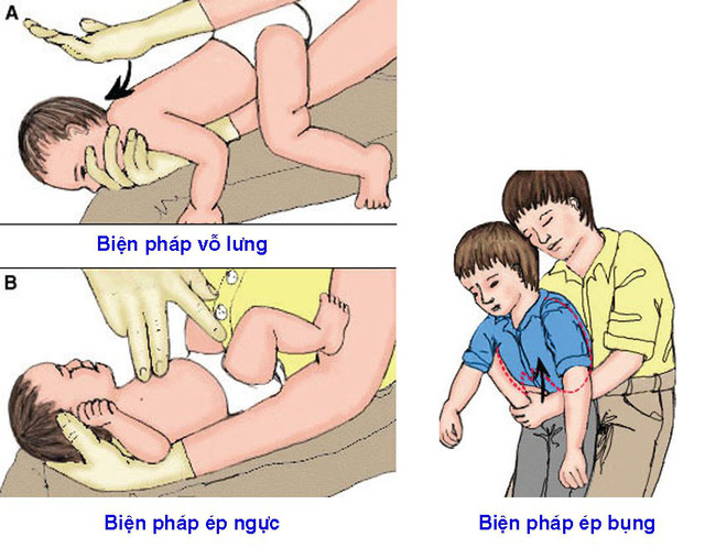   Với trẻ nhỏ có thể áp dụng biện pháp vỗ lưng, ép ngực để sơ cứu cho trẻ khi bị hóc dị vật  