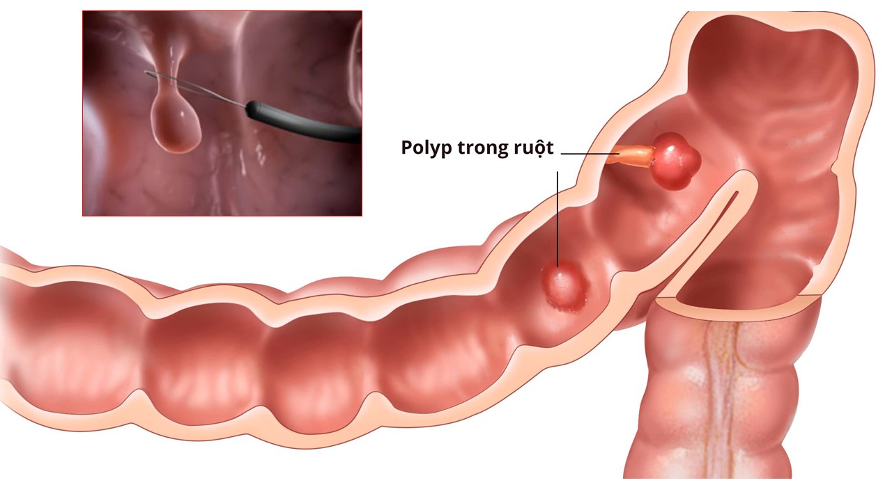 Polyp có thể xuất hiện tại nhiều vị trí trong đường tiêu hóa nhưng phổ biến nhất ở đại tràng