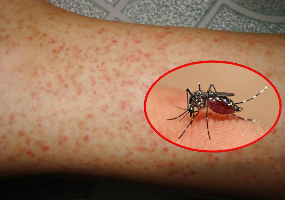 Thời tiết nắng nóng mùa hè là điều kiện thuận lợi cho muỗi truyền bệnh sốt xuất huyết phát triển và gây bệnh