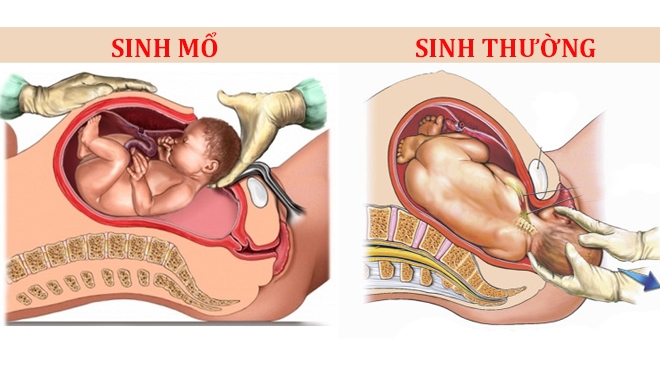 Mỗi phương pháp sinh thường và sinh mổ đều có những ưu và nhược điểm cho sức khỏe của cả mẹ và bé. Ảnh minh họa