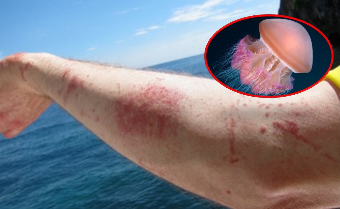 Khi đi tắm biển, sứa có thể quấn vào hoặc tấn công người gây ngứa, rát, phỏng nước... Ảnh minh họa