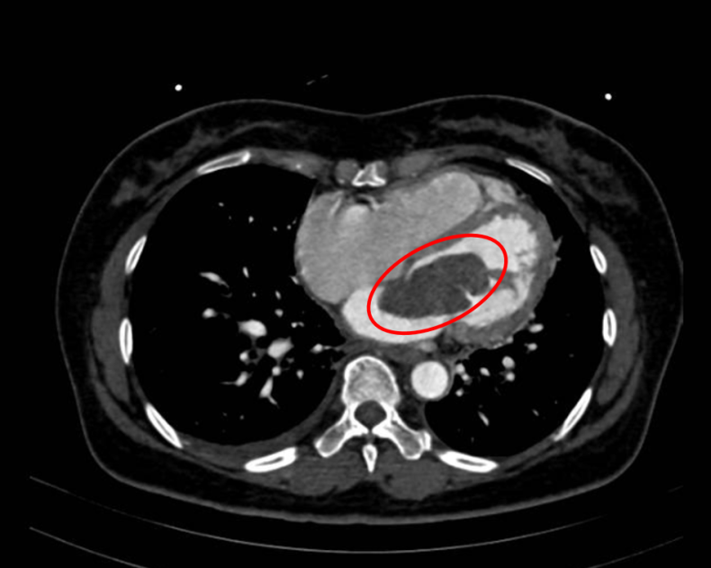Hình ảnh chụp MRI phát hiện khối u nhầy trong tim bệnh nhân H.