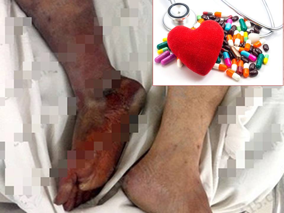 Uống thuốc tim mạch không đều, chân phải của người đàn ông bị họa tử và phải cắt cụt chân