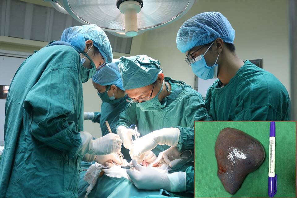 Các bác sĩ tiến hành phẫu thuật cắt lách và bóc tách khối u cho bệnh nhân