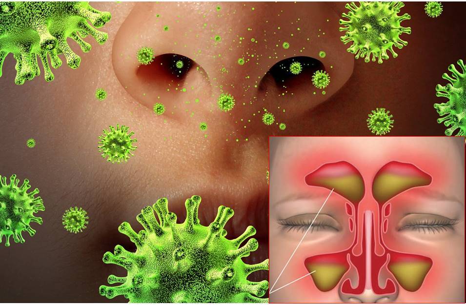 Viêm đa xoang mạn bội nhiễm nấm thường xảy ra trên cơ địa bệnh nhân có tình trạng suy giảm miễn dịch hoặc các bệnh mạn tính. Ảnh minh họa