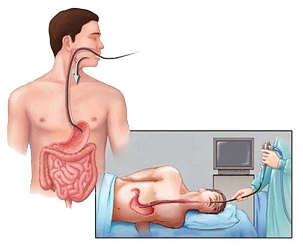 Hình ảnh mô tả nội soi dạ dày