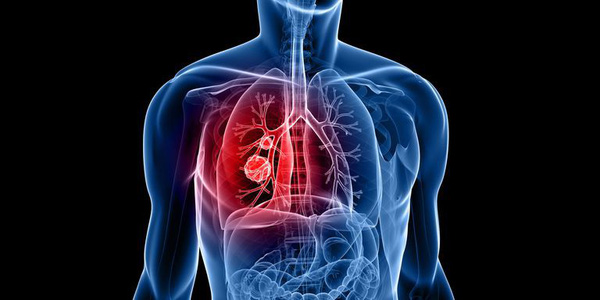 Khối u ở phổi chèn ép trực tiếp lên các cấu trúc vùng thắt lưng gây kích thích dây thần kinh đi qua ngực hoặc niêm mạc của phổi và gây đau lưng cho người bệnh. Ảnh minh họa