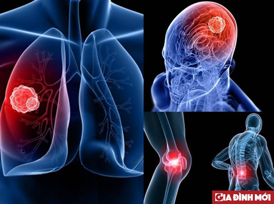 Nhiều bệnh nhân ung thư phổi phát hiện bệnh thì đã ở giai đoạn muộn và thường gây ra những biến chứng nguy hiểm
