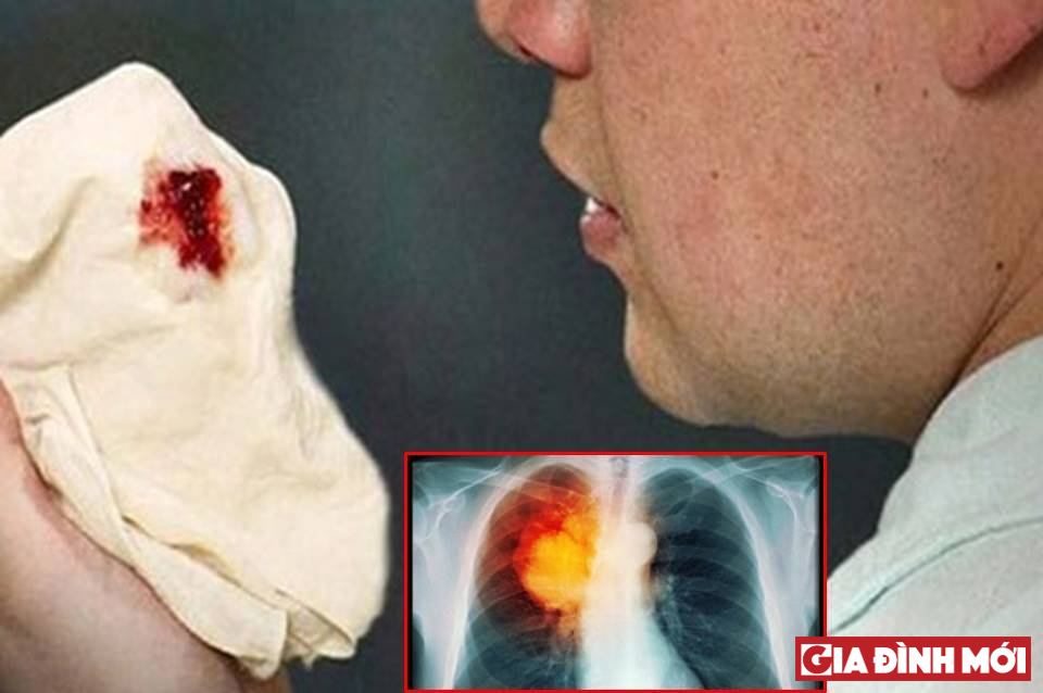 Ung thư phổi có thể gây chảy máu ở đường dẫn khí, khiến người bệnh bị ho ra máu