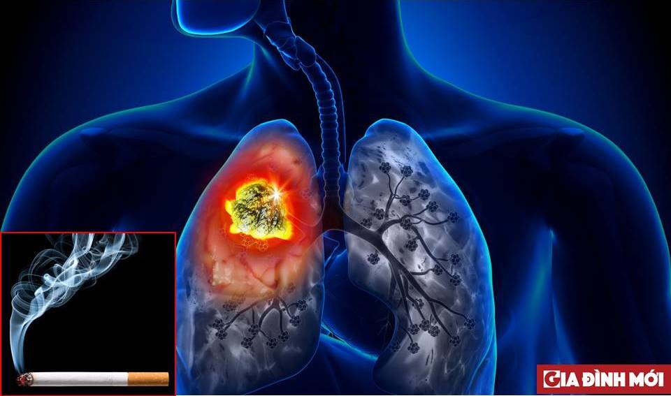 Khói thuốc lá là nguyên nhân hàng đầu gây bệnh ung thư phổi. Ảnh minh họa