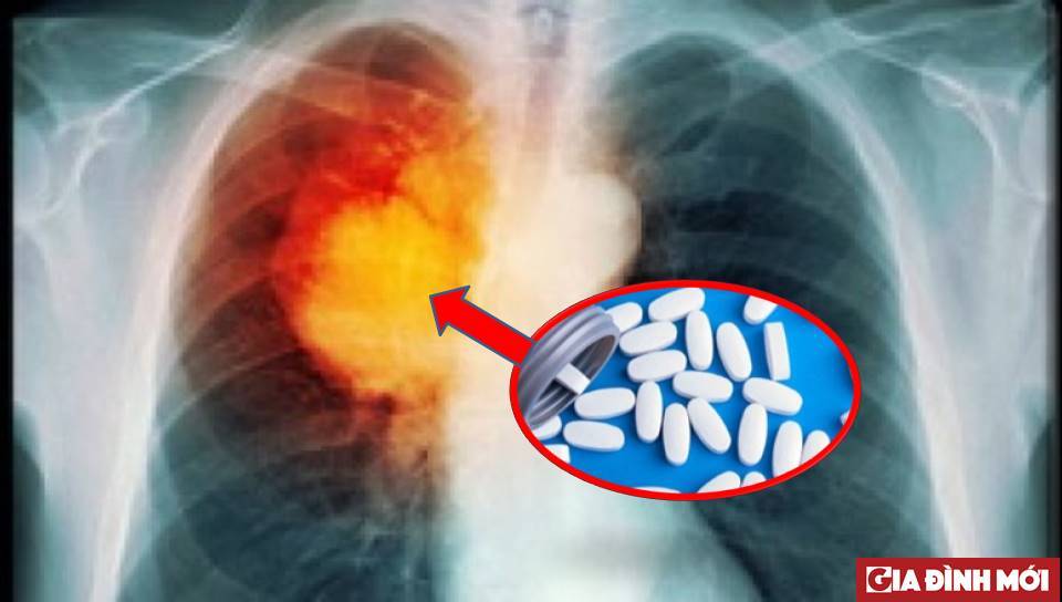 Thuốc điều trị đích giúp bệnh nhân ung thư phổi kéo dài sự sống lên được 3 – 4 năm. Ảnh minh họa