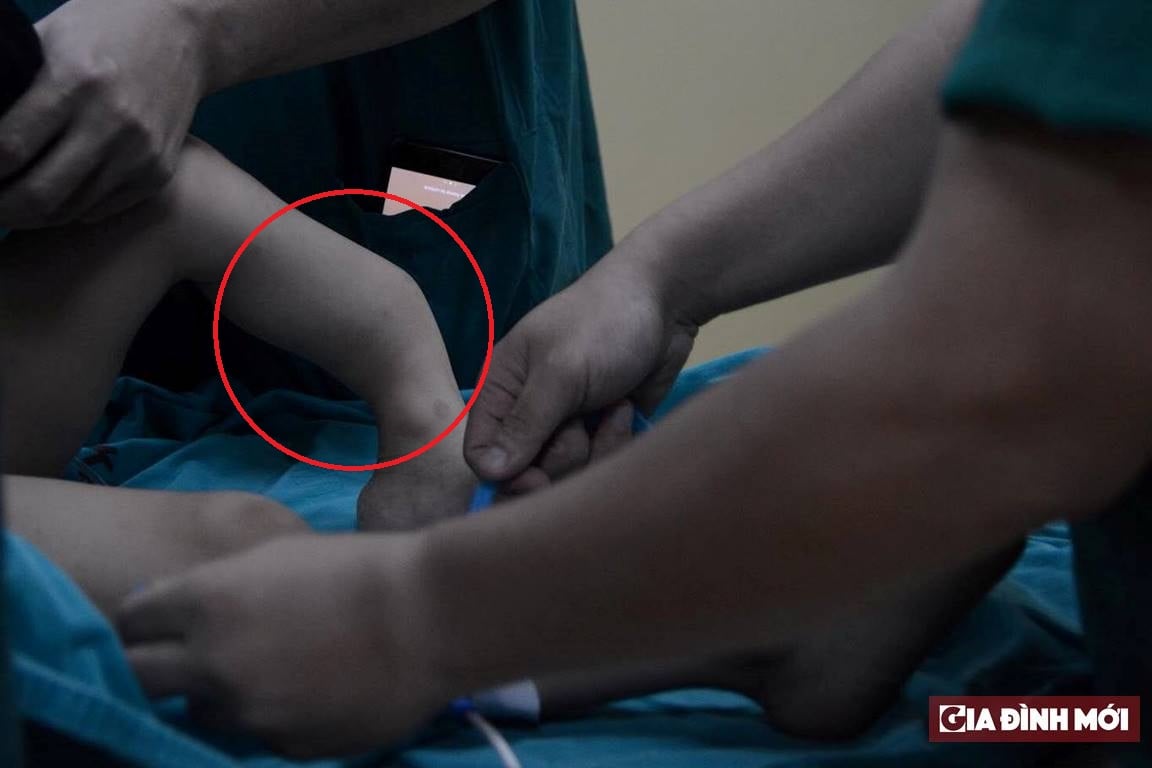 Các bác sĩ tiến hành phẫu thuật cho bệnh nhi bị dị tật ở chân