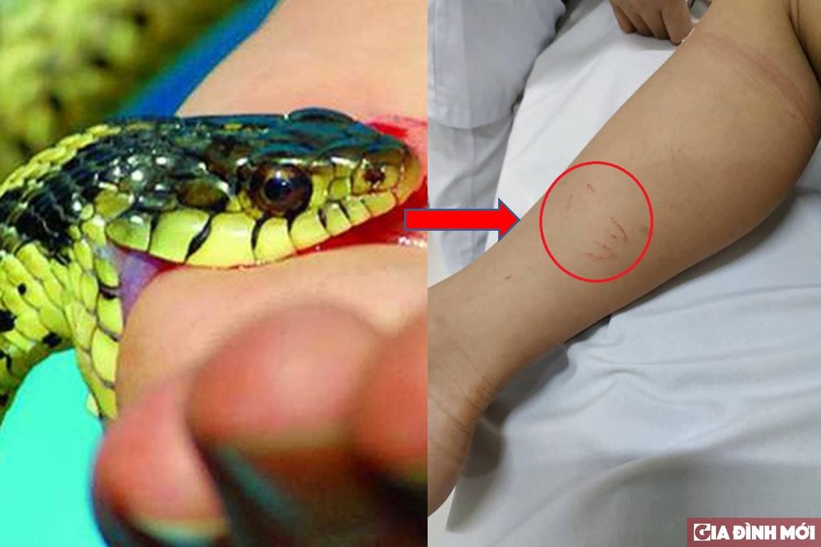Con rắn cắn vào chân cậu bé  