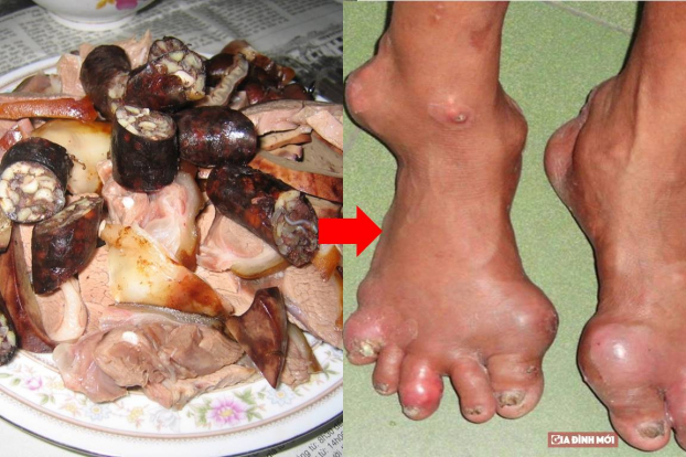   Chế độ ăn với các thực phẩm giàu đạm như thịt chó sẽ làm tăng acid uric trong máu, gây biến dạng khớp ở bệnh nhân bị gout. Ảnh minh họa  