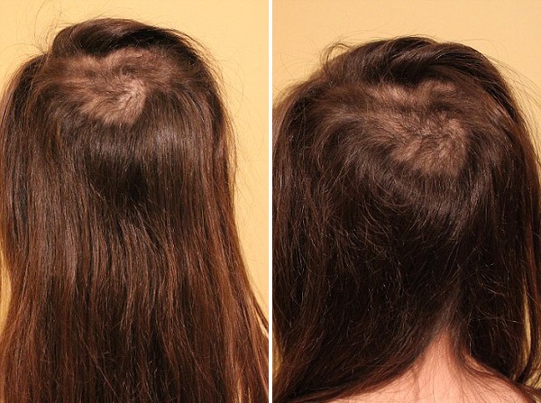   Nhổ tóc lâu dần sẽ thành nghiện, không kiểm soát được dẫn đến nhổ trụi tóc. Ảnh minh họa  