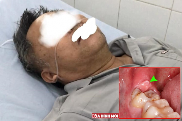   Người đàn ông suýt mất mạng vì ngộ độc thuốc tê khi đi nhổ răng số 8. Ảnh bác sĩ cung cấp  