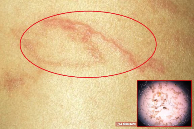   Những vết ngoằn ngoèo trên da, có di chuyển là dấu hiệu cảnh báo cơ thể bị nhiễm giun lươn. Ảnh minh họa  