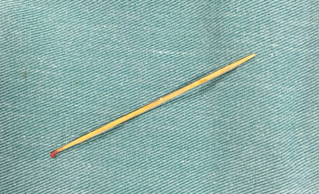   Chiếc tăm dài được lấy từ mông bệnh nhi  