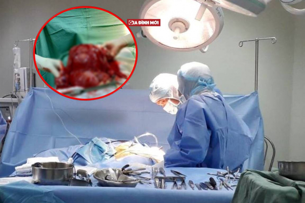   Bác sĩ tiến hành phẫu thuật lấy khối u nặng 4kg, to như thai nhi 7 tháng trong tử cung bệnh nhân  