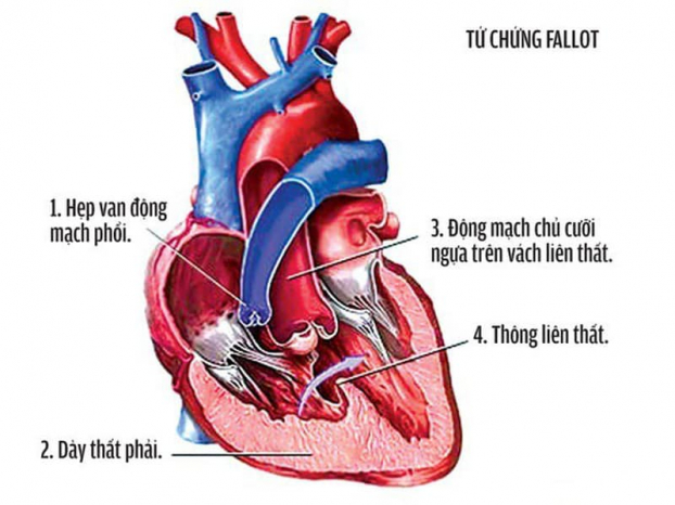 5 điều cha mẹ nên làm khi trẻ được chẩn đoán bệnh tim bẩm sinh 1