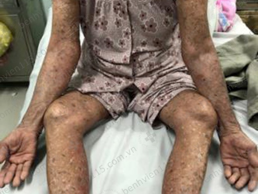   Toàn thân cụ bà bị ửng đỏ, bọng nước sau khi tự dùng thuốc điều trị bệnh gout  