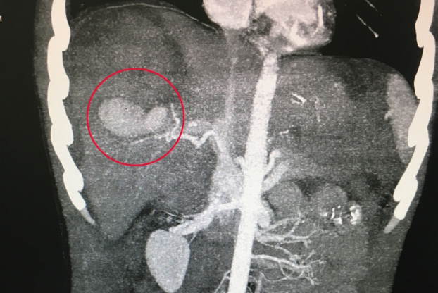   Hình ảnh khối giả phình tại gan của người bệnh (vùng khoanh tròn màu đỏ)  