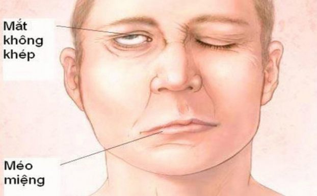   Biểu hiện chính của bệnh là liệt nửa mặt, méo miệng, mắt không nhắm kín. Ảnh minh họa  